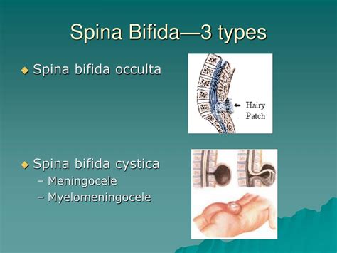 description of spina bifida